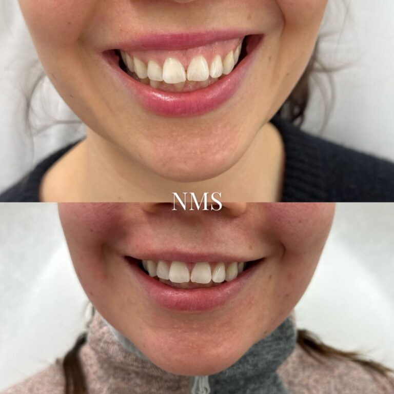 Ienhymy eli gummy smile – mistä on kyse ja miten sitä hoidetaan?