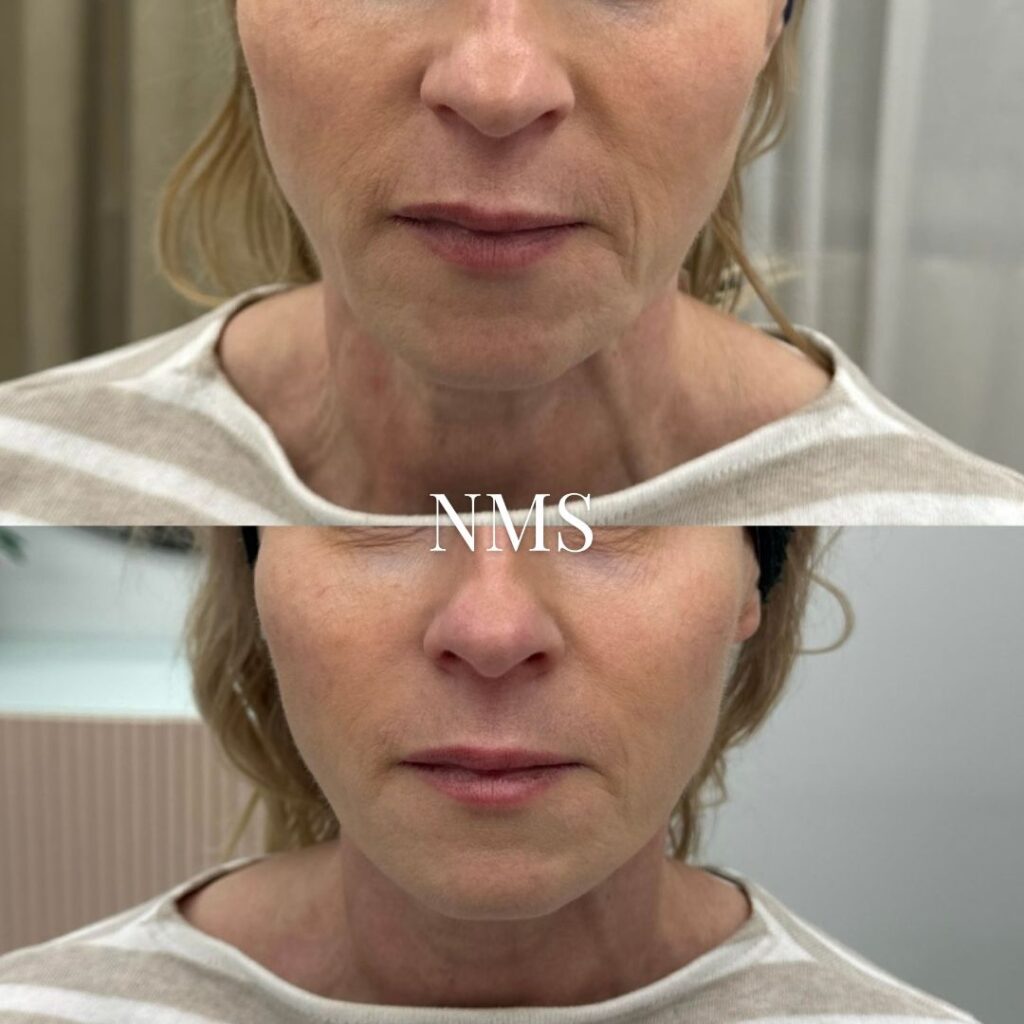 Exilis Ultra facelift