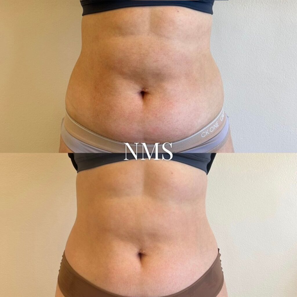 Exilis Ultra vatsan kiinteytys