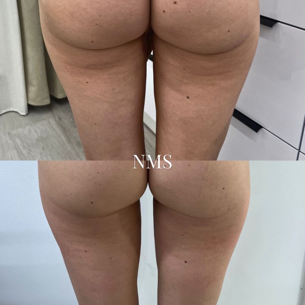 Exilis Ultra selluliitin hoito