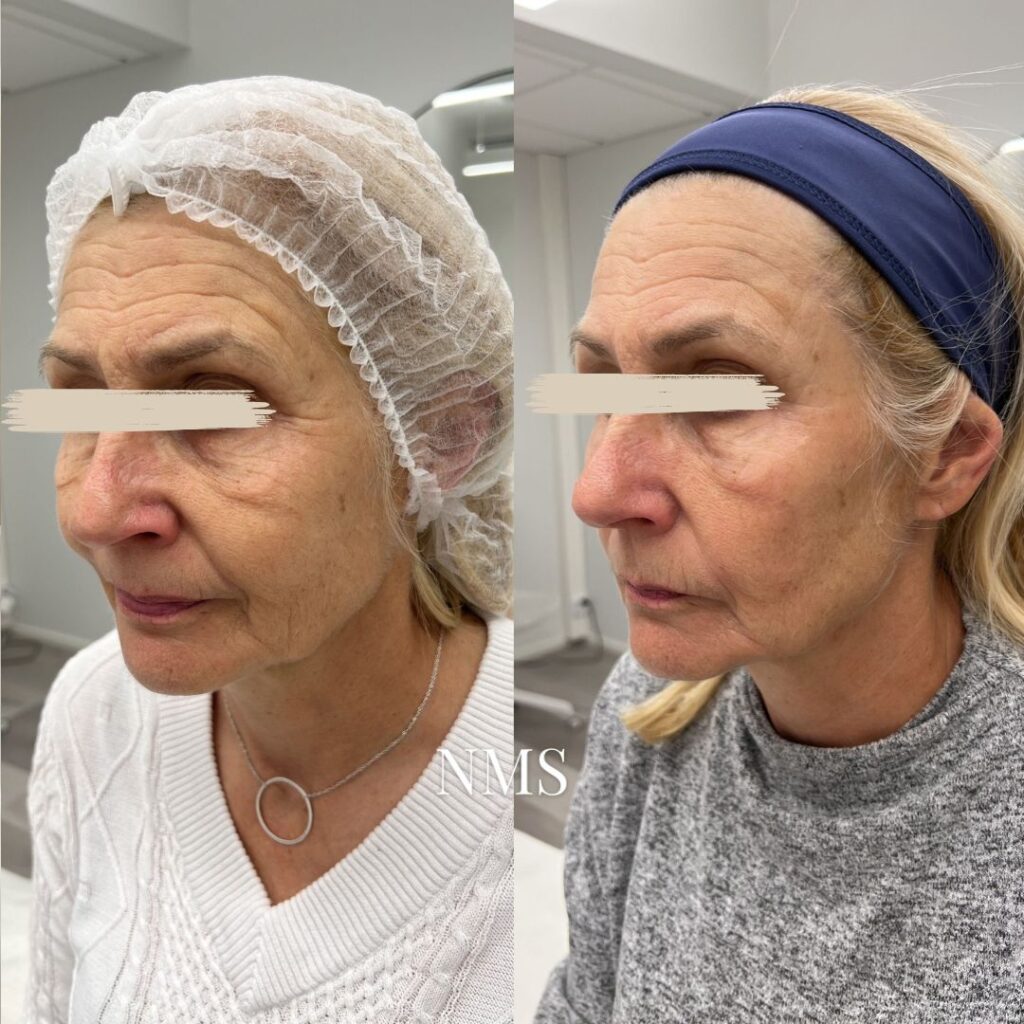 Exilis Ultra