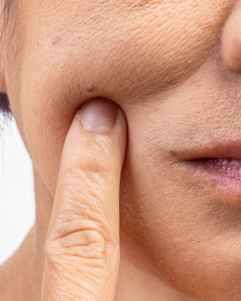 Keski -ja alakasvojen rypyt