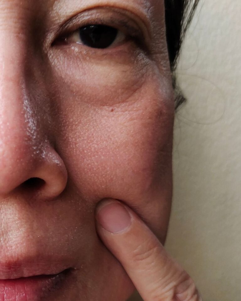 Malar bags eli pussit poskipäissä – mikä avuksi?